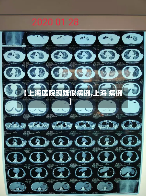 【上海医院现疑似病例,上海 病例】